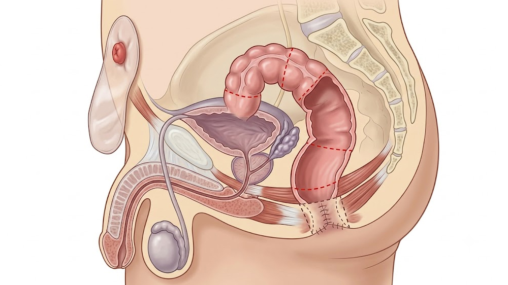 Abdomino Perineal Resection