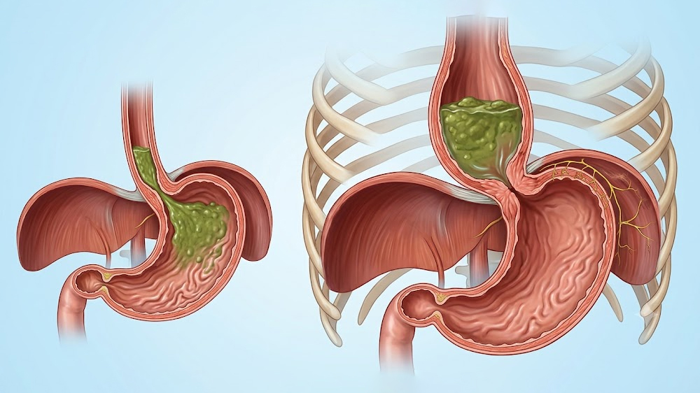 Achalasia Cardia