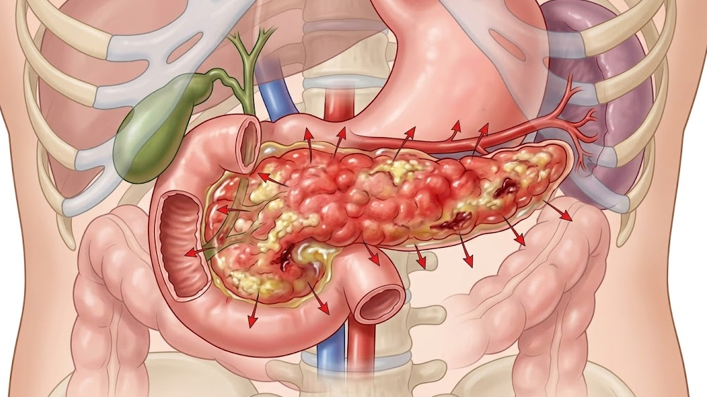 Acute Pancreatitis