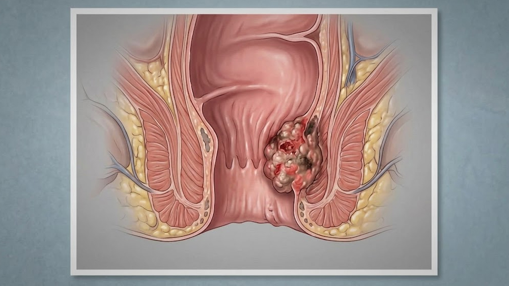 Anal Canal Cancer