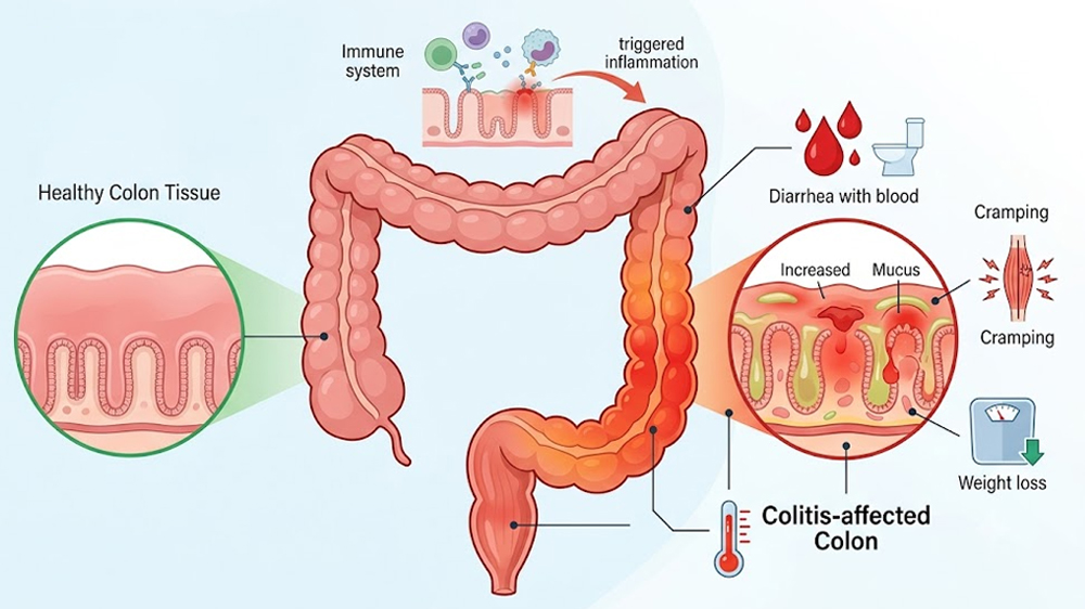 Colitis
