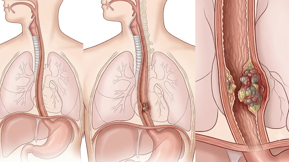 Esophageal Cancer