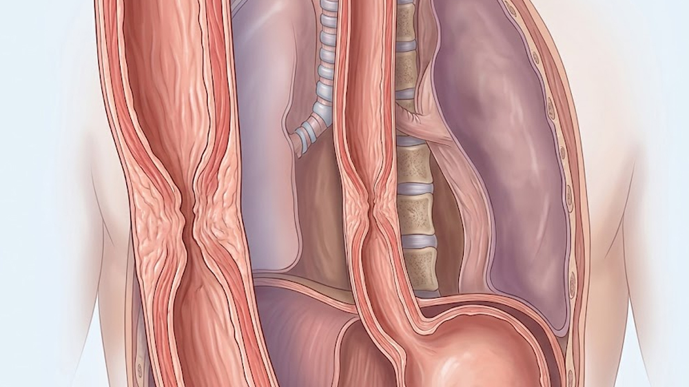 Esophageal Stricture