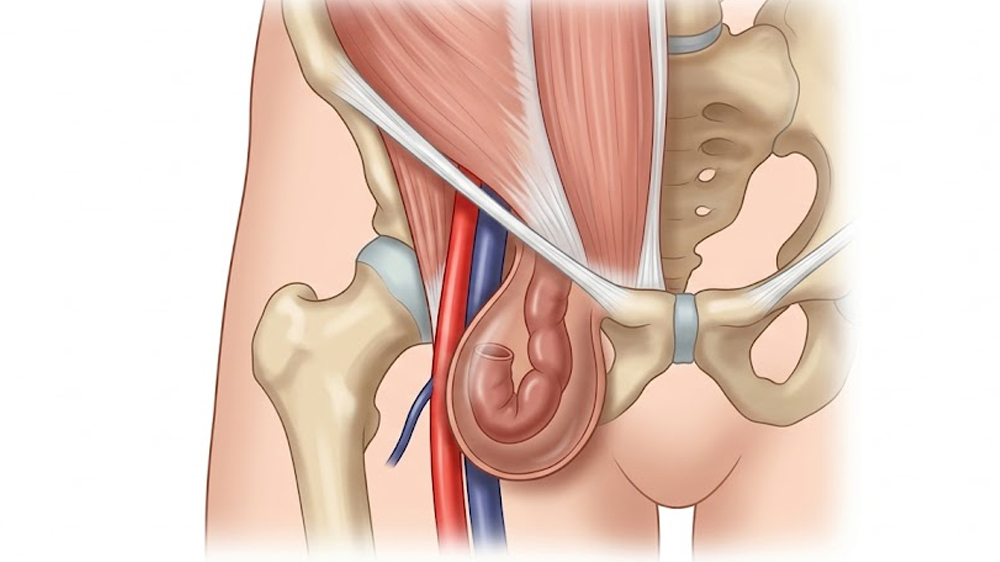 Femoral Hernia