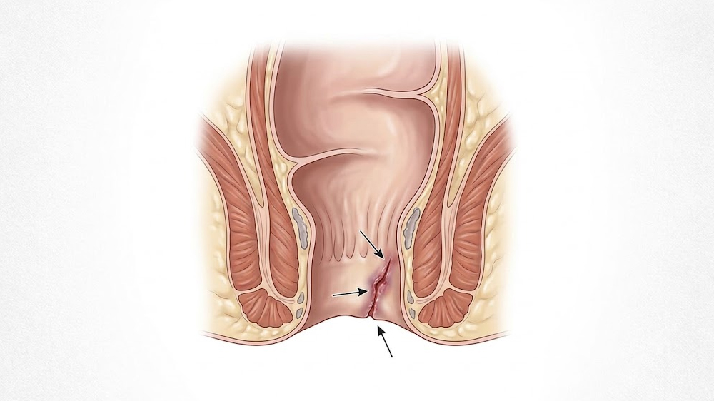 Anal Fissure