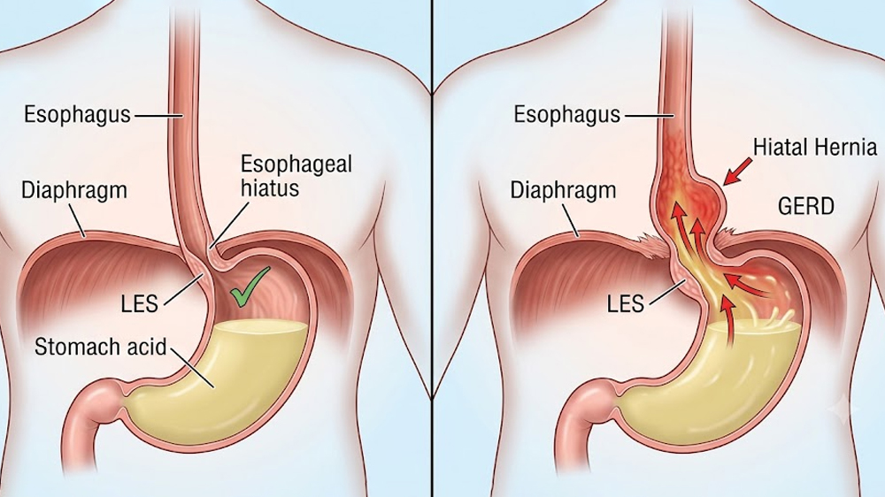 GERD & Hiatal Hernia
