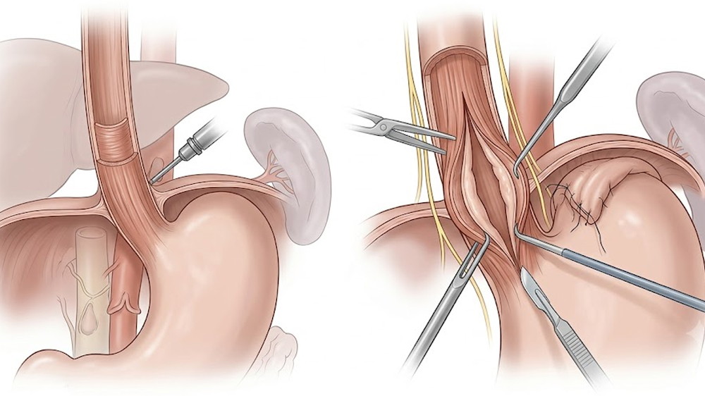 Heller's Myotomy