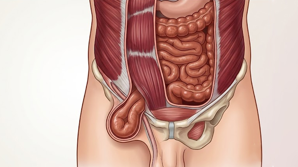 Inguinal Hernia