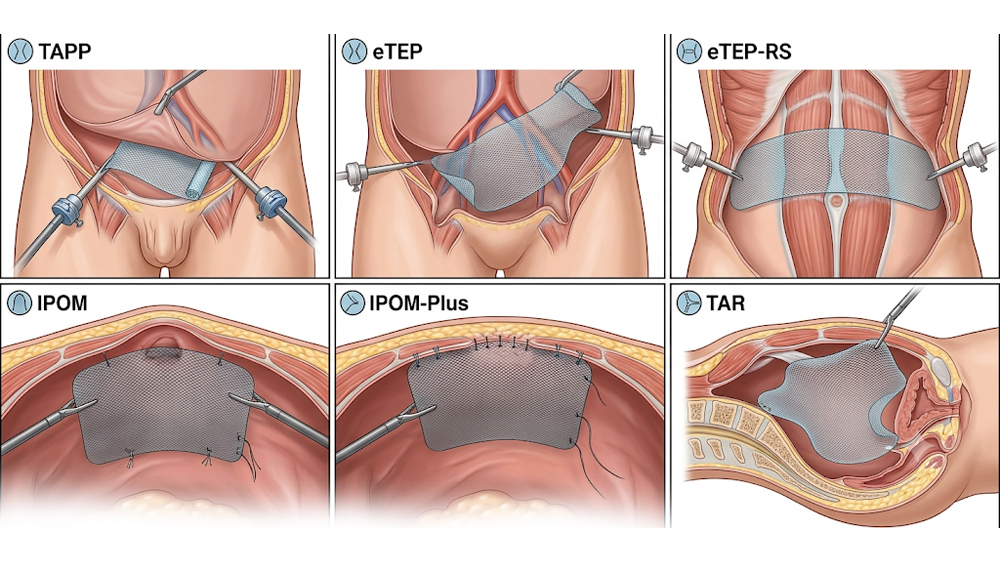 Laparoscopic Hernia Surgery