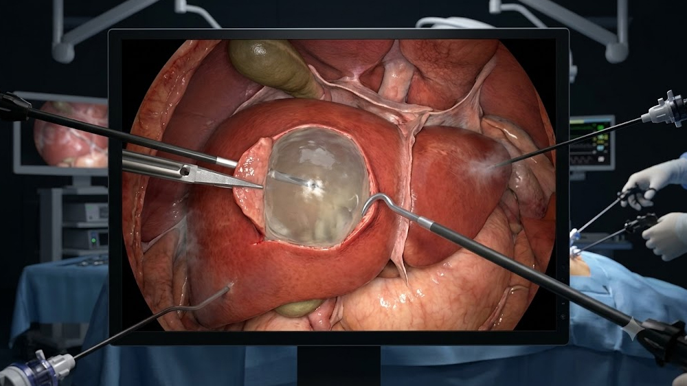 Laparoscopic Liver Cyst Excision
