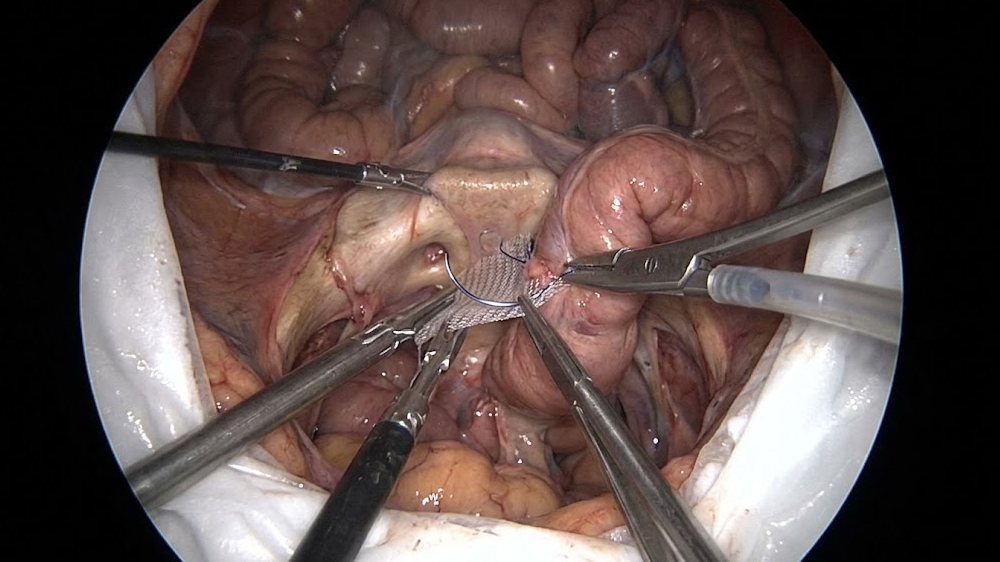 Laparoscopic Suture Rectopexy