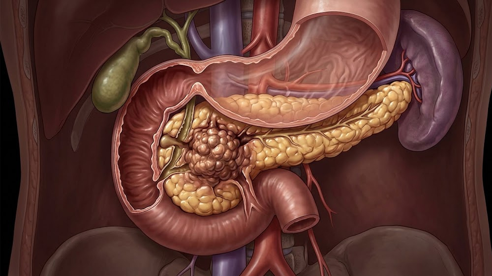 Pancreatic Cancer