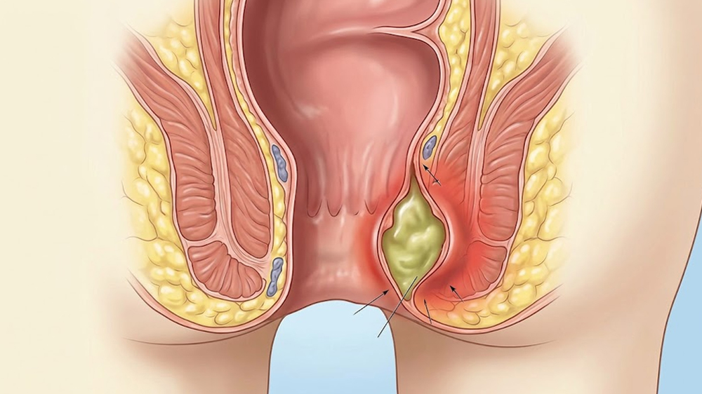 Perianal Abscess