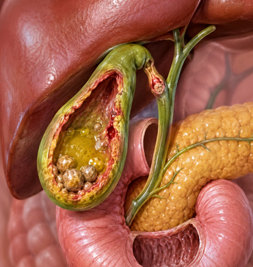 Gall bladder Diseases