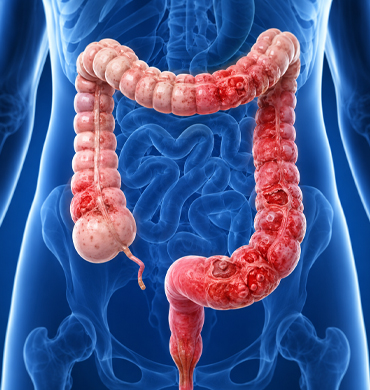 Large Bowel Diseases 